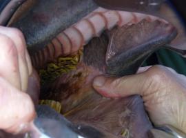 Severe cheek lacerations caused by sharp molar points